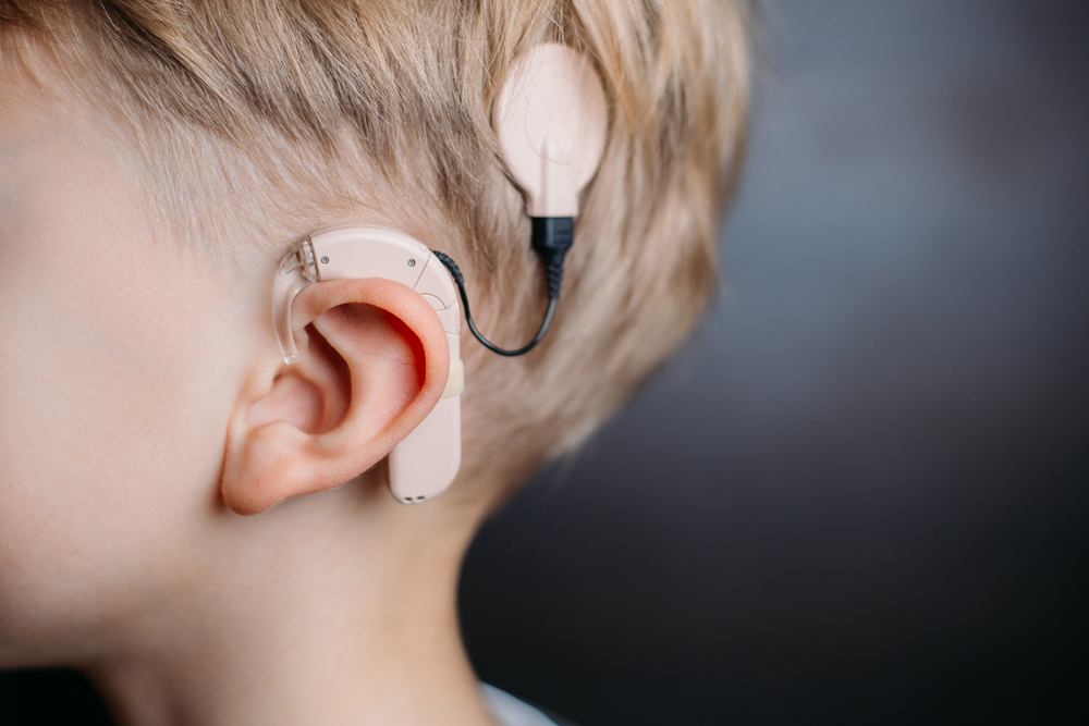 Photo of a child with cochlear implants