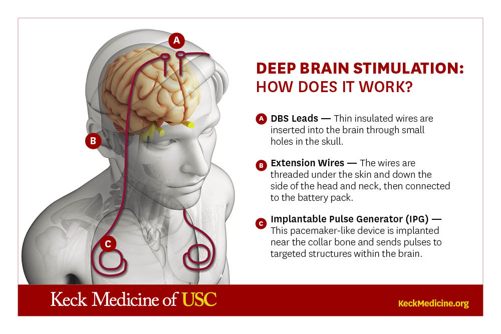 What Is Deep Brain Stimulation? - Keck Medicine Of USC What Is Deep ...